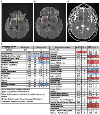 Atypical Case of VV1 Creutzfeldt–Jakob Disease Subtype: Case Report